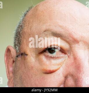 In der Nähe von älteren Mann Gesicht mit großen Schwellung der Augenlider nach der Operation. Stockfoto