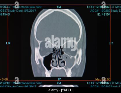 CT-Scan der männlichen mit nasennebenhöhlenentzündung (Sinusitis) Befüllung der linken Kieferhöhle. Deckt auch abgewichen Septum Stockfoto