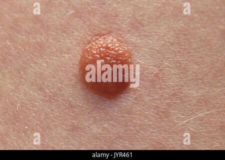 Unregelmäßige Schönheit Markierung, die Veränderungen auf der Haut bei Melanompatienten Stockfoto
