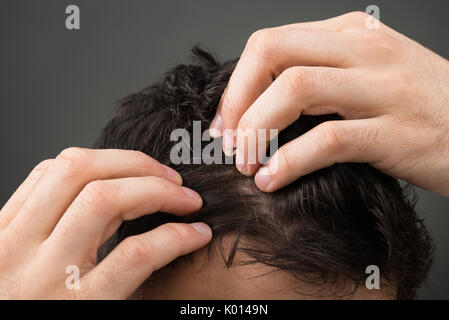 Zugeschnittenes Bild des Menschen leiden unter Haarausfall gegen grauer Hintergrund Stockfoto