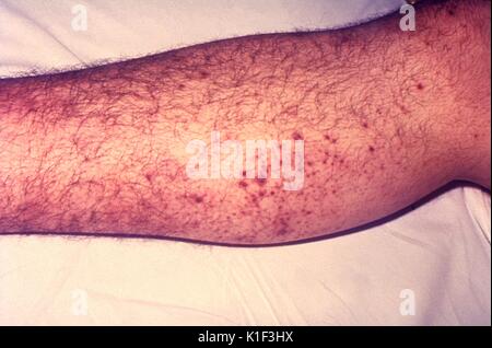 Hier sind kleine Blutungen auf der Haut von der Pest zum Opfer. Kapillare Zerbrechlichkeit ist eine der Manifestationen einer Pest Infektion, offensichtlich hier am Bein eines infizierten Patienten. Mit freundlicher CDC. 1990. Stockfoto