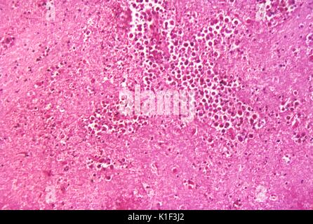 Unter einer Vergrößerung von 125X, diese photomicrograph eines Hirngewebe Muster zeigt die cytoarchitectural Veränderungen im Zusammenhang mit einem frei lebenden, Naegleria fowleri, amebic Infektion. Bei frei lebenden amebae infizieren das Gehirn oder Rückenmark, den Zustand als primäre amebic Meningoenzephalitis oder PAM bekannt ist. Frei lebende amebae, die zu den Gattungen Acanthamoeba, Balamuthia und Naegleria sind wichtige Ursachen von Krankheiten bei Menschen und Tieren, obwohl nur eine Holzart Naegleria, Naegleria fowleri, Krankheit beim Menschen führt. Sie PHIL3412, oder klicken Sie auf den folgenden Link, für eine illustrative depictio Stockfoto