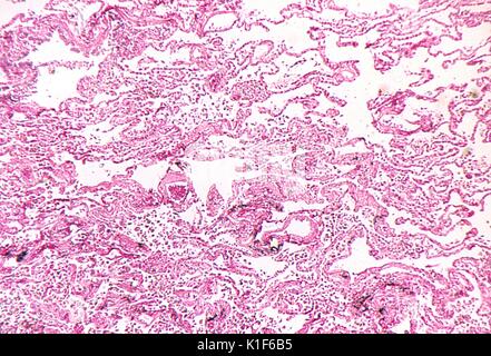 Photomicrograph von Lungengewebe demonstrieren Lungenentzündung in einem Fall der tödlichen menschlichen Einatmunganthrax, Mag. 50 x. Bild mit freundlicher Genehmigung von CDC/Dr. LaForce, 1967. Stockfoto