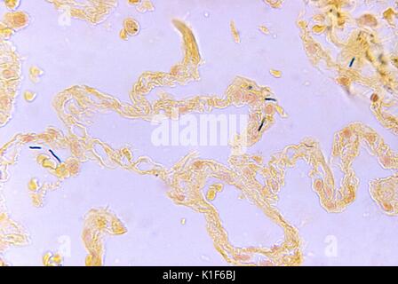 Bacillus anthracis in der Lunge. Photomicrograph von Bacillus anthracis in Lungengewebe in einem Fall der tödlichen Inhalation Anthrax, BandB Fleck, Mag. 500x. Bild mit freundlicher Genehmigung von CDC/Dr. LaForce, 1967. Stockfoto