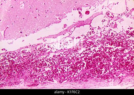 Meningealblutung aufgrund von Anthrax. Photomikrographie von Hirnhäuten, die eine hämorrhagische Meningitis aufgrund tödlicher Inhalation bei Anthrax zeigen, Mag. 125x. Mit freundlicher Genehmigung von CDC/Dr. LaForce, 1967. Stockfoto