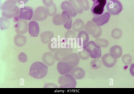 Diese blutausstrich Schliffbild offenbart ein babesia sp. tetrade Bildung. Babesiose, die mit Malaria verwechselt werden kann, wird von Hemo-einzelliger Parasiten der Gattung Babesia verursacht. Während mehr als 100 Arten gemeldet wurden, B. microti und B. divergens haben in den meisten menschlichen Fälle identifiziert. Bild mit freundlicher Genehmigung von CDC/Dr. Mae Melvin, 1973. Stockfoto