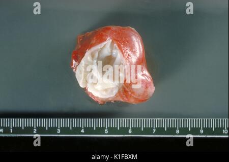 Grobe Pathologie von Membran und hydatid Tochter Zysten aus menschlichen Lunge. Parasiten. Bild mit freundlicher Genehmigung von CDC/Dr. I. Kagan, 1961. Stockfoto