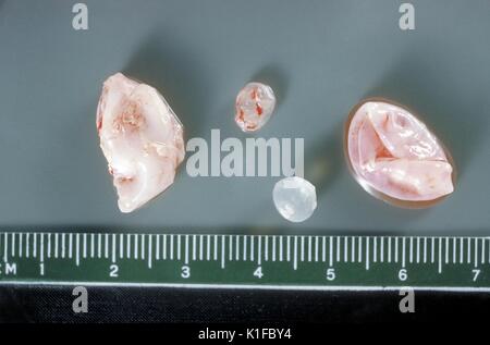 Grobe Pathologie von Membran und hydatid Tochter Zysten aus menschlichen Lunge. Parasiten. Bild mit freundlicher Genehmigung von CDC/Dr. I. Kagan, 1961. Stockfoto