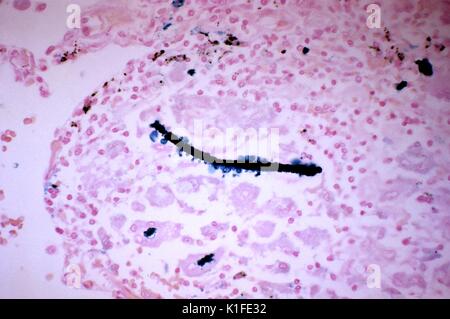 Histopathologie von eisenhaltigen Körper, Lunge, Diese photomicrograph offenbart histopathologic Veränderungen im Lungengewebe Muster gefunden, Anzeigen einer eisenhaltigen Körper. Eine Faser Asbest oder ähnliche Substanz, war überzogen von einer eisernen - Protein Komplex und durch Makrophagen umgeben. Die Probe wurde mit einer Preußischen blaue Fleck verarbeitet. Bild mit freundlicher Genehmigung von CDC/Dr. Edwin S. Ewing, Jr., 1971. Stockfoto