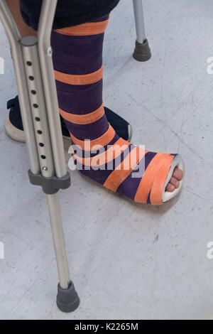 Ein cast auf einem Bein mit orange und lila Streifen. Stockfoto