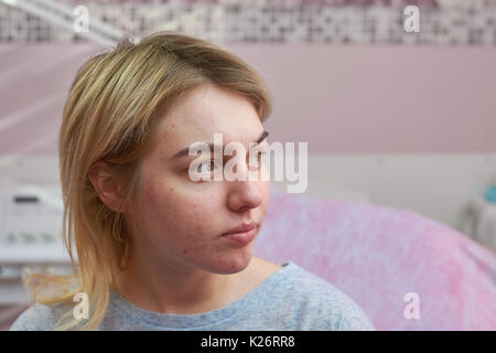 Kaukasische Mädchen mit Akne. Problematische Haut. Die Symptome der allergischen Reaktion. Stockfoto