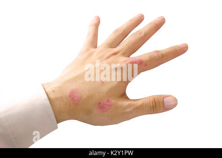 Psoriasis auf weißen isoliert Stockfoto