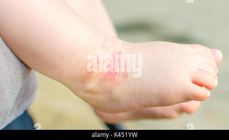 Juckreiz atopische Dermatitis baby Fuß Stockfoto