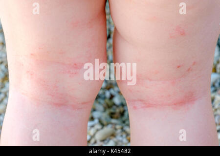 Hautreizungen neugeborenen closeup atopische Dermatitis Beine Kratzer Stockfoto