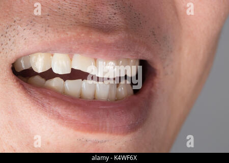 Verletzungen der Zähne oder Zähne bei männlichen Brechen. Trauma und Nervenschäden der verletzten Zahn, bleibenden Zähne Verletzungen. Stockfoto