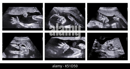 Collage von medizinischen Bildern von Ultraschall Anomalie auf einem weiblichen Fötus 20 Wochen in die Schwangerschaft scan, in der Hand des Kindes, Kopf, Füße, Beine, Wirbelsäule und Stockfoto