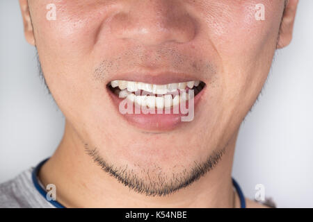 Hässlich Lächeln zahnmedizinisches Problem. Verletzungen der Zähne oder Zähne bei männlichen Brechen. Trauma und Nervenschäden der verletzten Zahn, bleibenden Zähne Verletzungen. Stockfoto