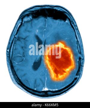 Hirntumor. Farbige Magnetresonanztomographie (MRT) Scan eines axialen Schnitt durch das Gehirn mit einem metastasierten Tumor. Unten links ist der Tumor (rot-gelb) Dieser Tumor innerhalb einer Gehirnhälfte erfolgt ist; die andere Hemisphäre ist auf der rechten Seite. Die Augäpfel - nicht sichtbar - sind oben. Metastasierendem Krebs ist eine Krankheit, die vom Krebs an anderer Stelle im Körper. Metastasierendem malignen Hirntumoren sind. In der Regel verursachen Sie Gehirn Kompression und Nervenschäden Stockfoto