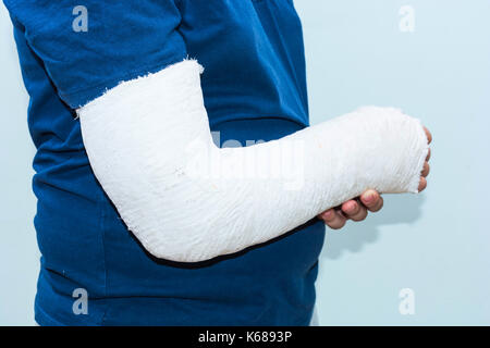 Junge mit gebrochenen Arm, Gips am Arm als Therapie. In der Nähe von white ist ein junger Mann mit langem Arm Gips/Glasfaser Gusseisen für das Handgelenk, Arm und Ellenbogen Stockfoto