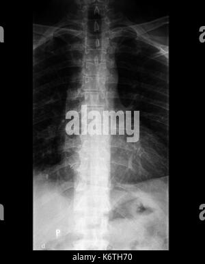 Ein x-ray des Körpers und der Wirbelsäule und Nacken Stockfoto