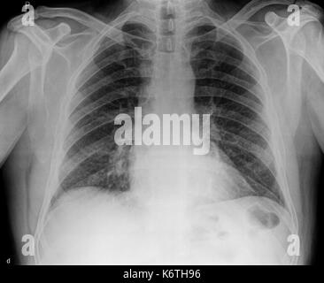 Ein x-ray des Körpers und der Wirbelsäule und Nacken Stockfoto