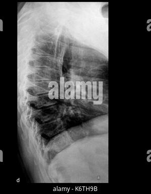 Ein x-ray des Körpers und der Wirbelsäule und Nacken Stockfoto