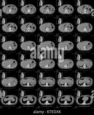 Bauch und Brust Anatomie. Serie der Computertomographie (CT) der Querschnitte durch den oberen Teil des Bauches, der untere Teil der Brust eines 30-jährigen Patienten. Sie zeigen die Leber (links), Darm (rechts), der Wirbelsäule (unten), Nieren (unten links und rechts), Herz (oben in der letzten Zeile der Bilder) und unteren Lappen der Lunge (schwarz in der letzten Zeile der Bilder). Stockfoto