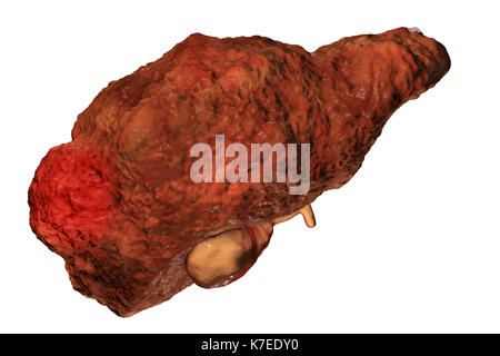 Zirrhotische Leber mit Leberzellkarzinom, computer Artwork. Eine der Ursachen für die Erkrankung an einem Leberzellkarzinom ist die virale Infektion, insbesondere mit Hepatitis C-Viren (HCV). Hepatitis C ist die häufigste Ursache der chronischen Hepatitis, zirrhose der Leber weiterkommt. Viren verursachen Zelltod (Nekrose) in der hepatischen Läppchen, die zu einer Vernarbung führt. Dies verursacht, dass die Leber eine raue Oberfläche auf und statt der üblichen glatten gesundes Aussehen klumpig erscheinen. Die Krankheit ist unumkehrbar und führen zu Leber Karzinom. Stockfoto