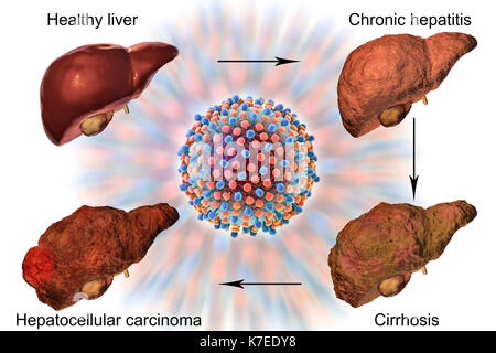 Das jeweilige Stadium der menschlichen Leber eine Erkrankung der Leber und Hepatitis virus, computer Abbildung. Stockfoto