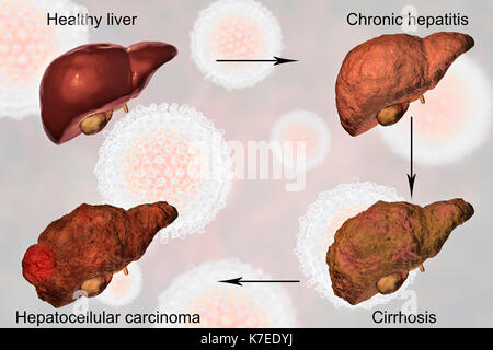Das jeweilige Stadium der menschlichen Leber eine Erkrankung der Leber bei Hepatitis-C-Virusinfektion, computer Abbildung. Stockfoto