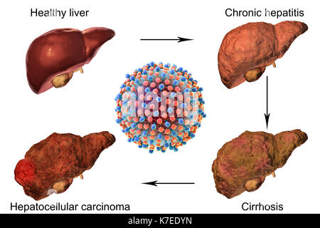 Das jeweilige Stadium der menschlichen Leber eine Erkrankung der Leber bei Hepatitis-C-Virusinfektion, computer Abbildung. Stockfoto