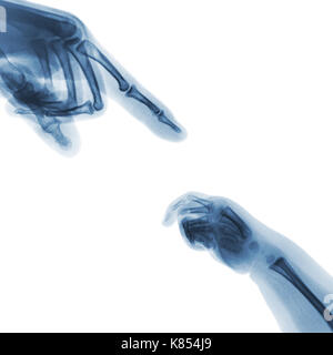 X-Ray's nach Hand punkt Finger an der oberen Seite und Baby's Hand an der unteren Seite. Stockfoto