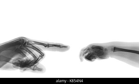 X-Ray's nach Hand zeigen mit dem Finger auf der linken Seite und Baby's Hand auf der rechten Seite. Leere Fläche an die obere Seite. Stockfoto