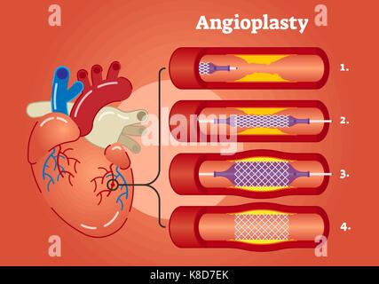 Abgebildete Schema zeigt Angioplasty Konzept in 4 Schritten Stock Vektor