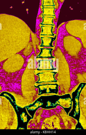 WIRBELKÖRPER ARTHROSE, CT-SCAN Stockfoto