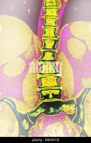 WIRBELKÖRPER ARTHROSE, CT-SCAN Stockfoto