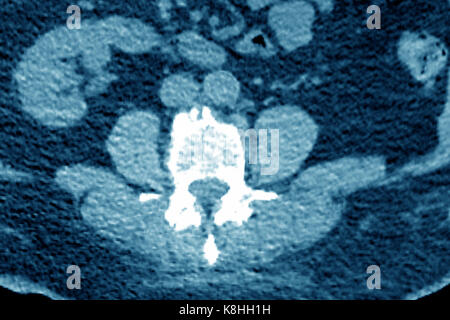 WIRBELKÖRPER ARTHROSE, CT-SCAN Stockfoto