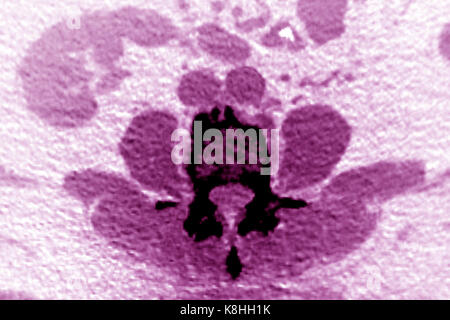 WIRBELKÖRPER ARTHROSE, CT-SCAN Stockfoto