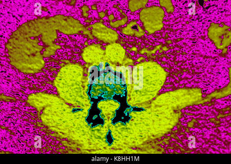 WIRBELKÖRPER ARTHROSE, CT-SCAN Stockfoto