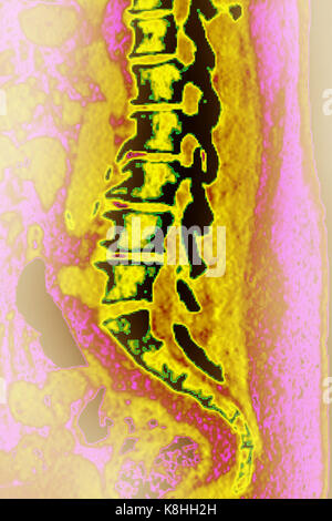 WIRBELKÖRPER ARTHROSE, CT-SCAN Stockfoto