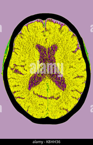 ZEREBRALE ATROPHIE, CT-SCAN Stockfoto