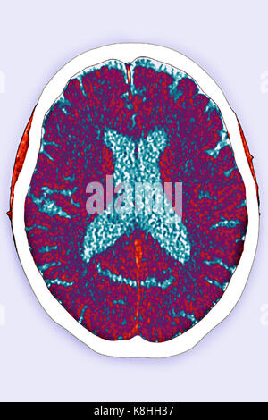 ZEREBRALE ATROPHIE, CT-SCAN Stockfoto