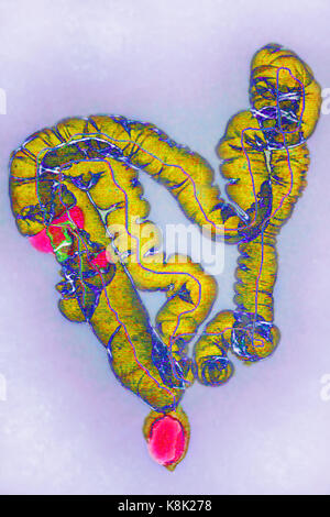 Darmkrebs CT-Scan Stockfoto