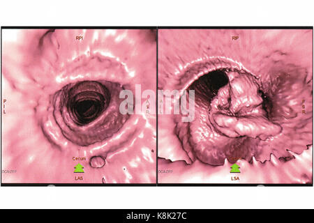 Darmkrebs CT-Scan Stockfoto