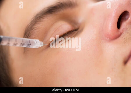 Close-up des Menschen Die Behandlung von Falten im Gesicht in Schönheit Klinik Stockfoto