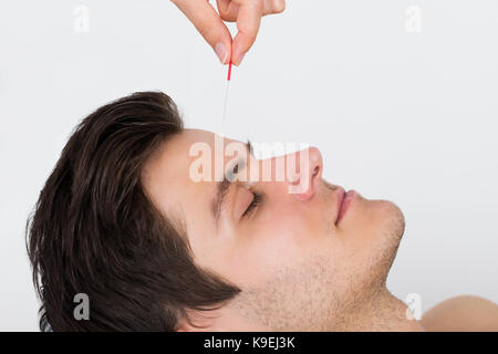 Close-up des jungen Mannes, die Akupunktur Behandlung Stockfoto