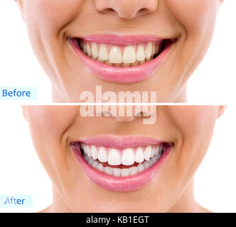 Weiß werden - Behandlung bleichen, vor und nach, Frau Zähne und Lächeln, Nahaufnahme, auf weissem isoliert Stockfoto