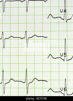 Ekg-Test zeigt, dass die elektrische Aktivität des Herzens. Stockfoto