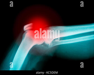 X-ray von menschlichen Arm mit gebrochenen Knochen mit rot markieren Stockfoto
