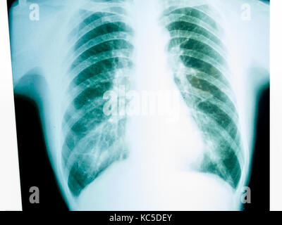 X-ray von einem menschlichen männlichen Brust Stockfoto